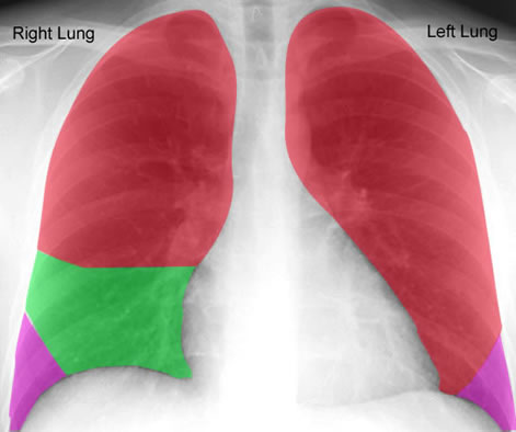 Review: Lobes of Lungs Anteriorly, CT Scan Overview: Chest -- Health